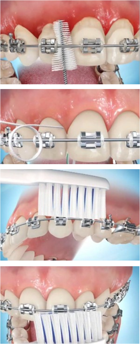Come pulire l'apparecchio ortodontico
