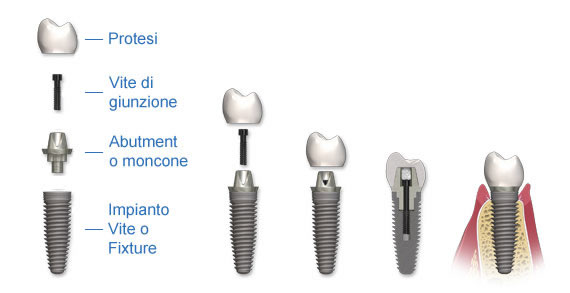 struttura-impianto-dentale-abutment-protesi